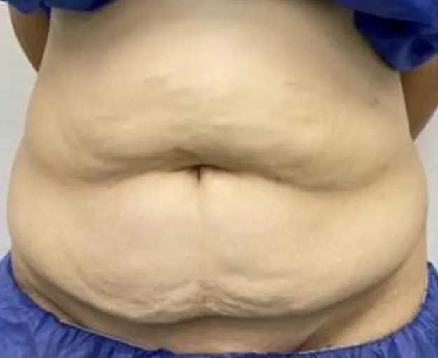  HD tummy tuck — before